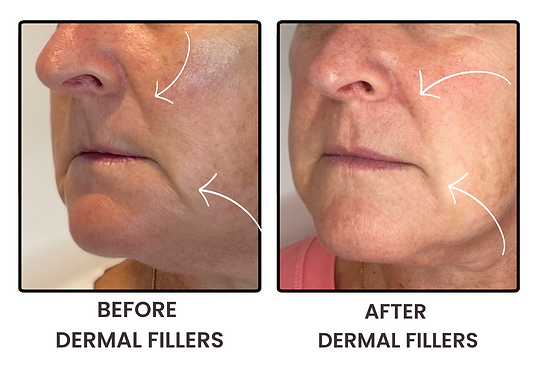 alt="Nasolabial and marionette line filler before and after – Esthetics UK, Staines"