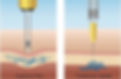 difference between hyaluron pen and normal needle injection
