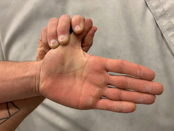 ThumbSided Wrist Pain in Climbers A Case for De Quervain’s Tenosynovitis