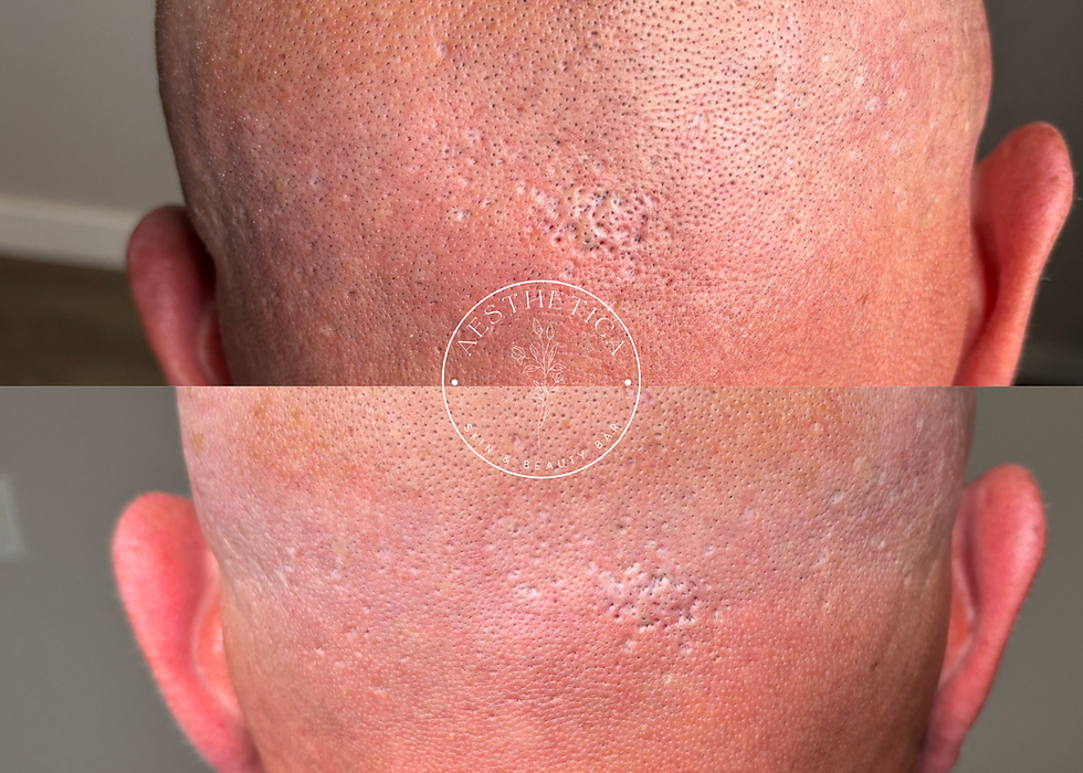 SkinPen Before & After 1 session