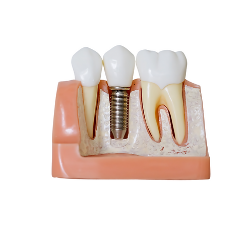 implante dental en cartagena