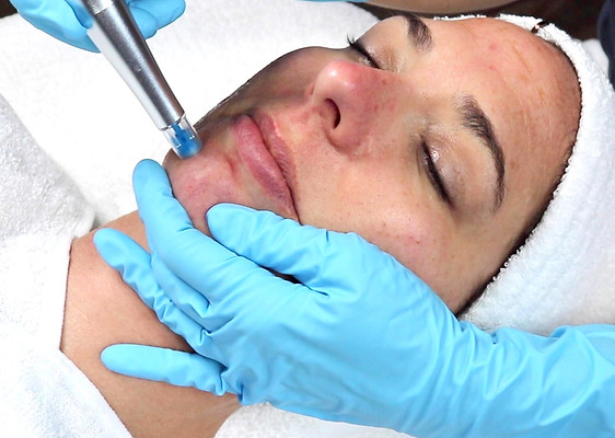 Rez%20NanoFacial%20Shot%201_edited.jpg