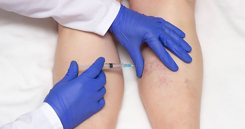 escleroterapia-varices-medellin.jpg