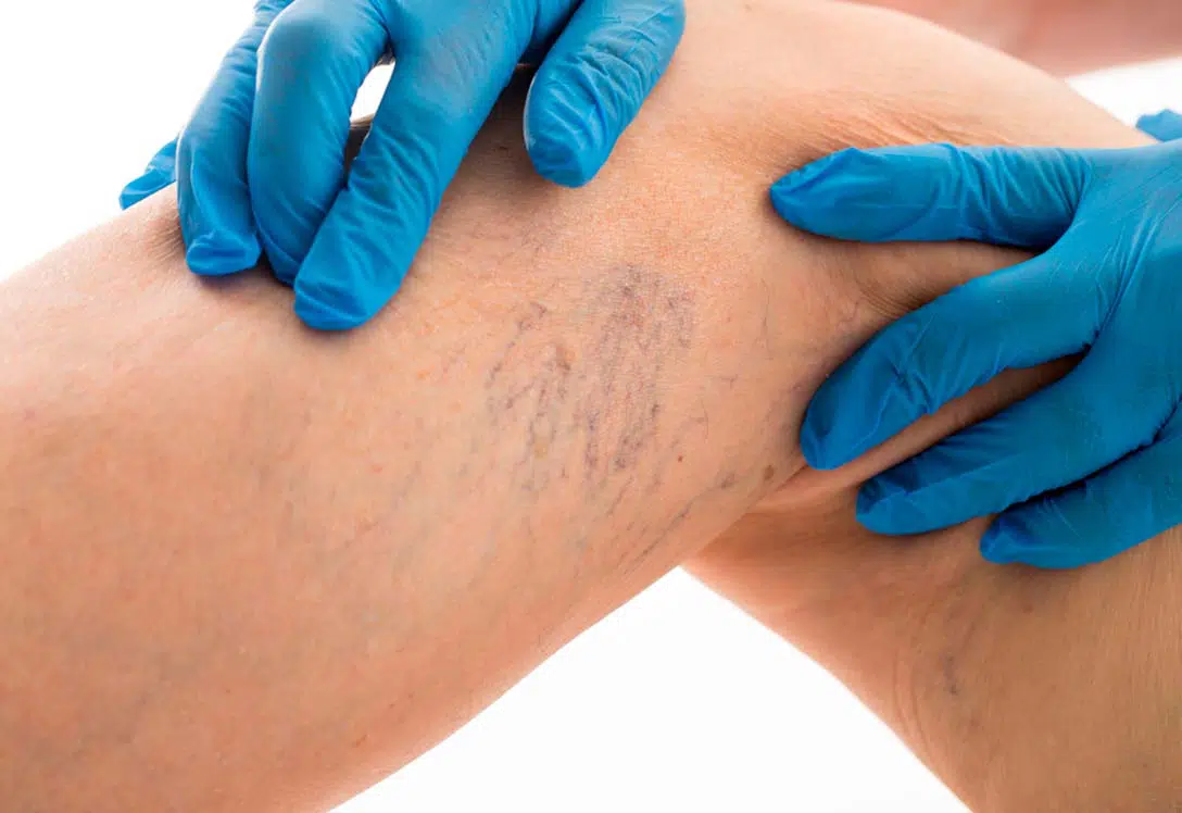paciente-varices-piernas.webp
