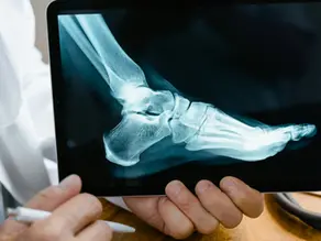 Understand All Deep Tissue Injury Stages and How Physical Therapy Helps Prevent Complications. Click Here!