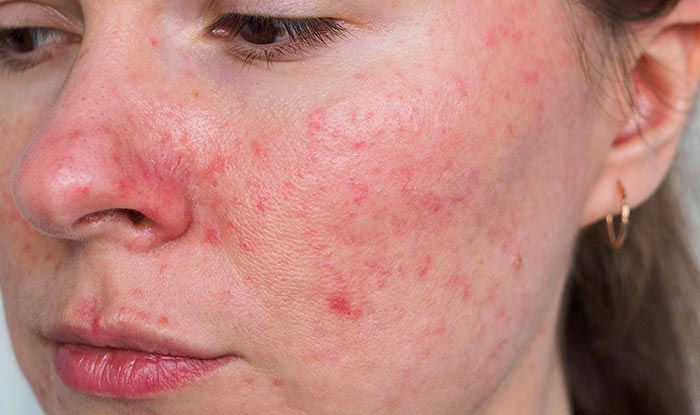 https://my.clevelandclinic.org/health/diseases/12174-rosacea