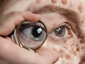 Skin Tags