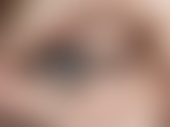 Skin Tags