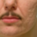 atrophic-acne-scars-article-ft_edited_edited.jpg