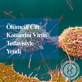 ÖLÜMCÜL CİLT KANSERİNİ VİRÜS TEDAVİSİYLE YENDİ