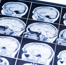 Neuroplasticity and the Brain’s Ability to Heal
