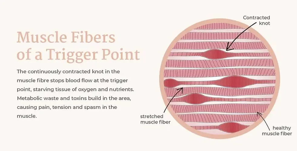 muscles fibers trigger point