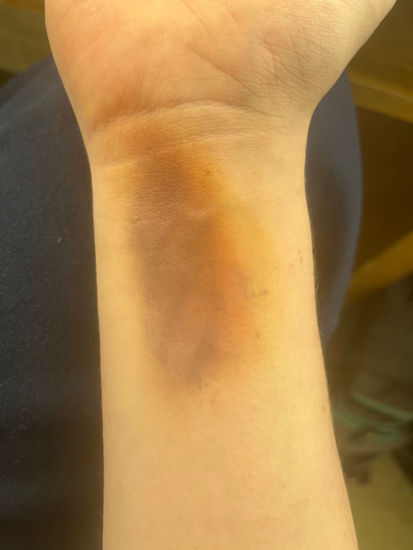 Scar and Burns Makeup