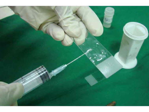 Fine Needle Aspiration Cytology (FNAC)