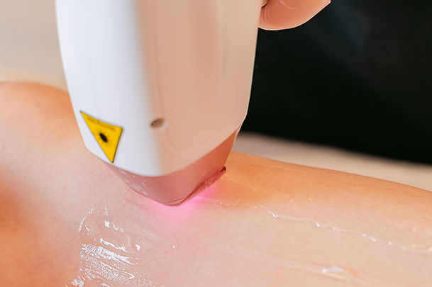 Laserontharing voor mannen rug en borst