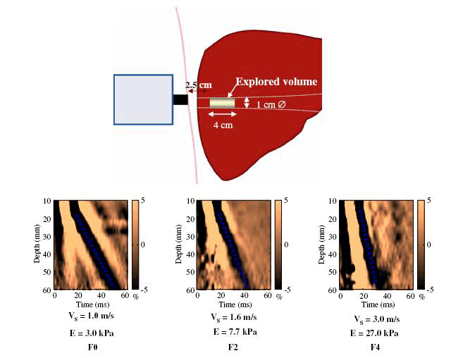 Fibroscan ekran.gif