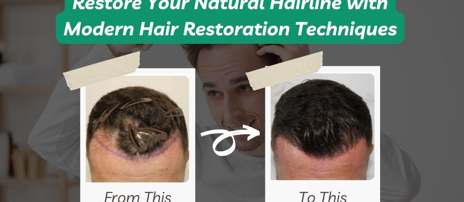 Restore Your Natural Hairline with Modern Hair Restoration Techniques