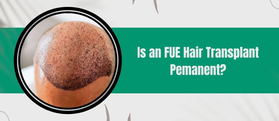 Is an FUE Hair Transplant Permanent?