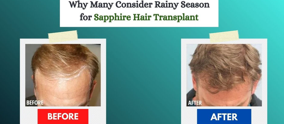 Why Many Consider Rainy Season for Sapphire Hair Transplant