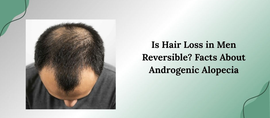 Is Hair Loss in Men Reversible? Facts About Androgenic Alopecia
