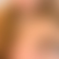 Seu cabelo caiu e não cresce mais? Pode ser alopecia cicatricial