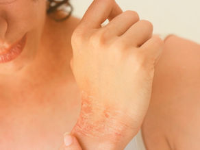 Carcinoma de células escamosas: Um tipo de câncer de pele