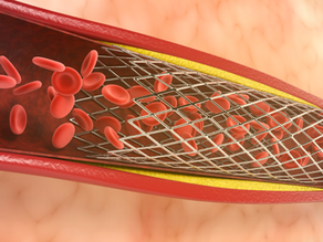 Érick Jacquin coloca stents: por que esse procedimento pode salvar vidas?