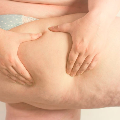 Não é só perna grossa. Conheça o lipedema