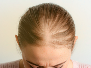 Calvície em homens e mulheres: entenda as diferenças na queda de cabelo