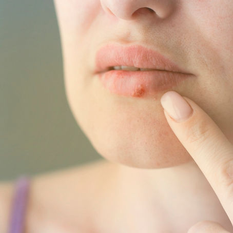 Entenda mais sobre herpes e o que a doença pode causar