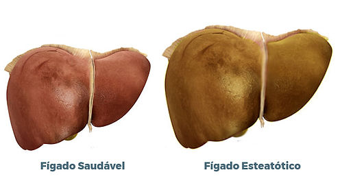Esteatose Hepática (Gordura no fígado) - Elastografia