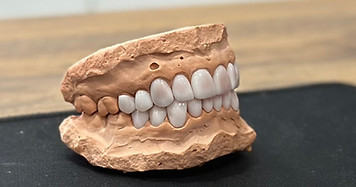 porcelain veneers