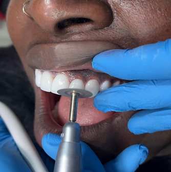 Porcelain Veneers in Colombia
