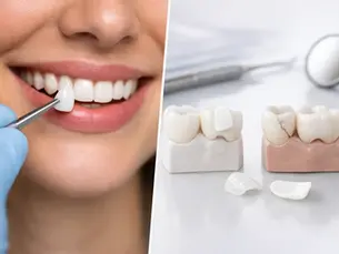 Faccette dentali pro e contro: cosa sapere