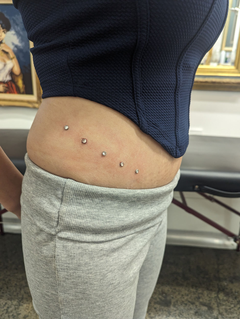 5x Dermal