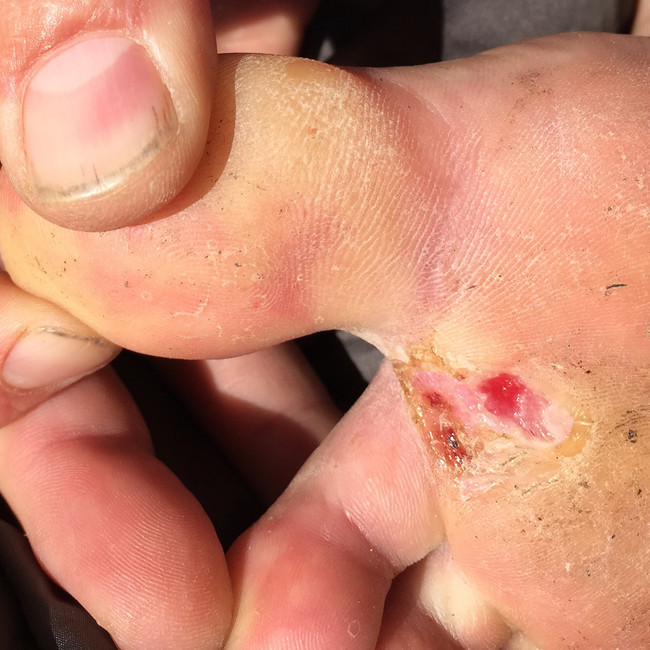 blister.jpeg
