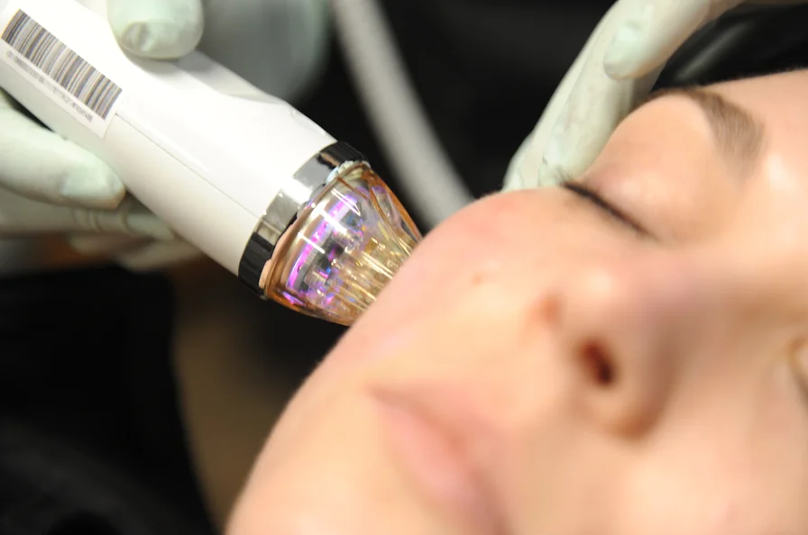 Microneedling.webp