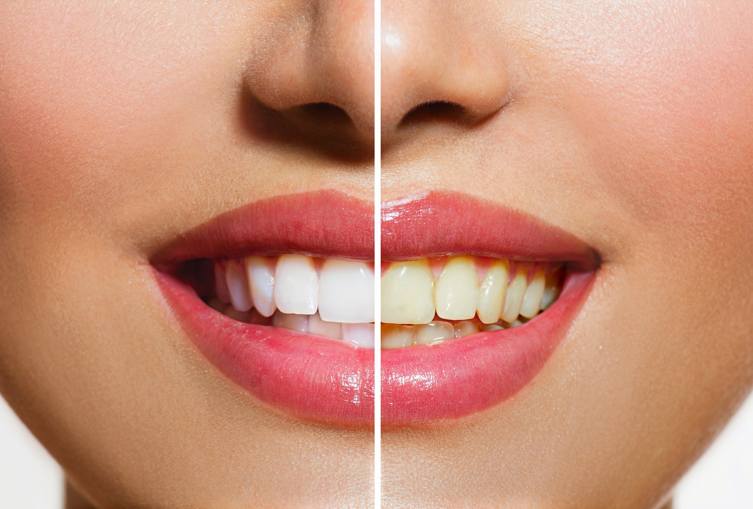 BLANQUEAMIENTO DENTAL