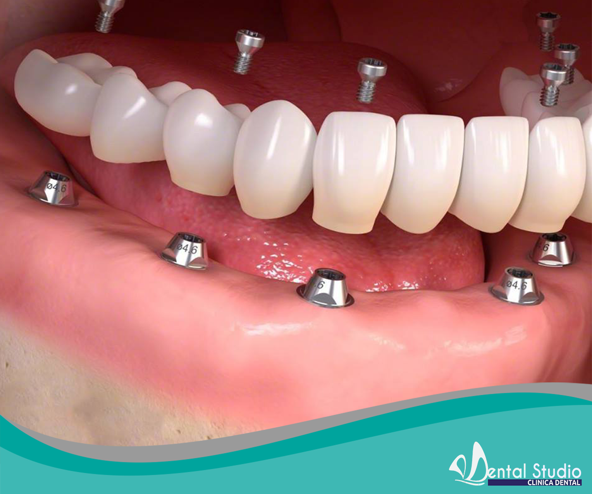 IMPLANTES DENTALES