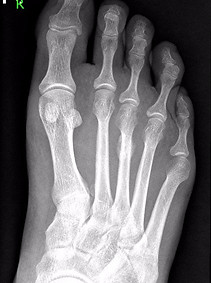 Stress fracture of metatarsal
