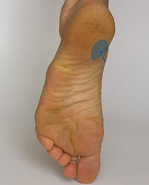 Plantar fasciitis