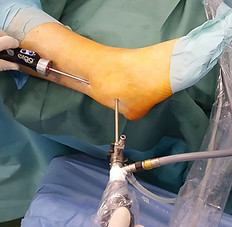Tendoscopy of peroneal (fibular) tendons