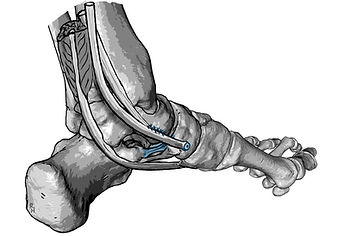 transfer FDL, dysfunction of PTT