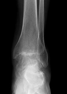 Osteoarthritis of ankle joint