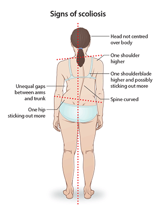 Scoliosis