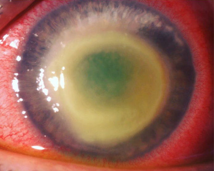 This picture is from a patient with a classic acanthamoeba infection in their cornea (front portion of the eye). This is an extremely serious parasitic infection of the cornea that should be treated quickly. Storing and handling contact lenses improperly can lead to an increased risk of acanthamoeba infection caused by an amoeba which is found commonly in water, soil, air, cooling towers, heating, ventilating, and air conditioning (HVAC) systems, and sewage systems.
