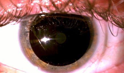 Prosthetic Contact Lens Light Sensitivity Arizona Scottsdale Dr. Morrison.jpeg