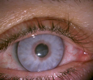 prosthetic colored contact lens dr morrisona rizona.jpg
