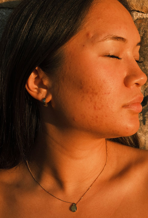 modell med acne
