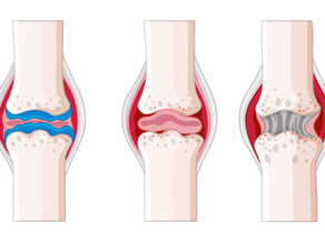 💡Arthrose cause : comprendre pourquoi vos articulations se fatiguent